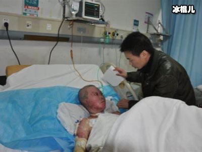 曾经重度烧伤为挽留丈夫不惜下跪，如今的她活的更加美丽了！