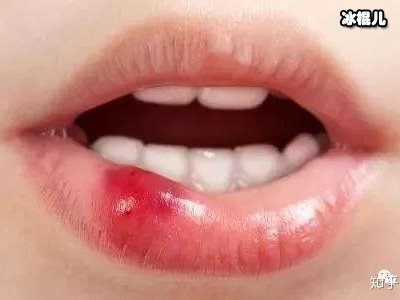 得了唇炎怎么办？教你快速缓解