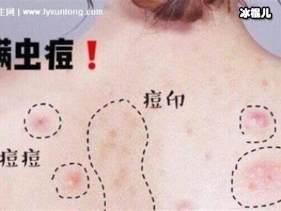 床上的四个迹象表明螨虫已经盯上了你，背部的痤疮可能是螨虫在工作