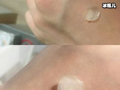 水胶体痘痘贴的龙头企业“尼科美缔可”